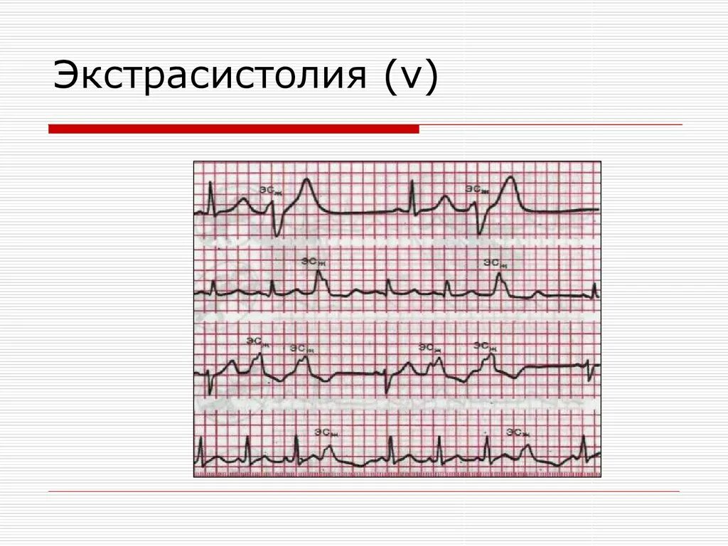 Аберрантная суправентрикулярная экстрасистолия. Кампанула розовая. Суправентрикулярная экстрасистолия на экг. Одиночные нжэ. Аберрантные наджелудочковые экстрасистолы.