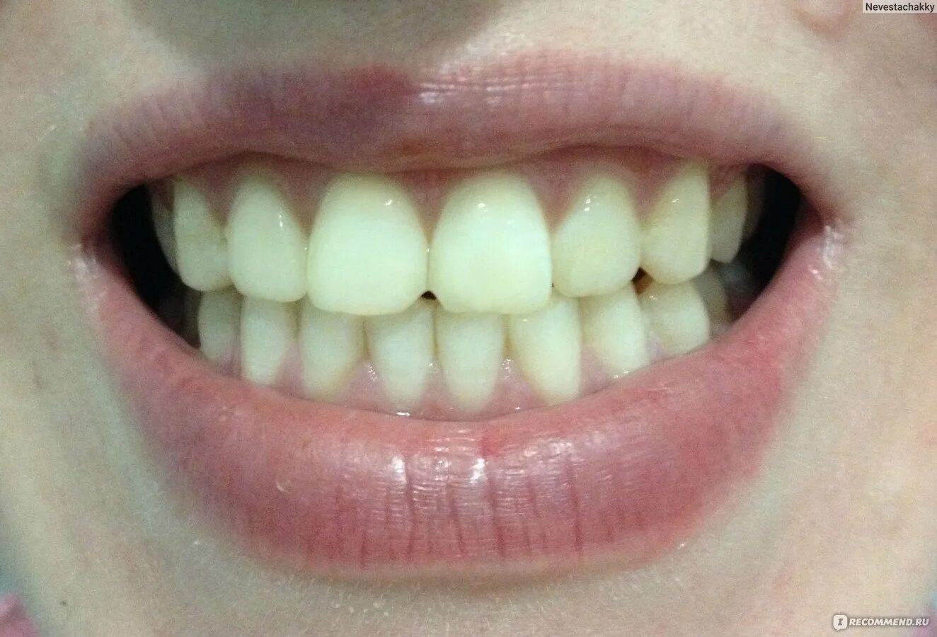 Чистка зубов улан удэ. Зубы черные как отбелить. Отбеливание зубов находка. Пожелтела эмаль от антибиотиков. Что делать если зубы желтые и не отбеливаются.