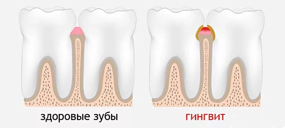 Десна на английском. Язвенно некротический гингивит. Десна на английском. Пародонтоз оголение шейки зуба. Элемент строения зуба.