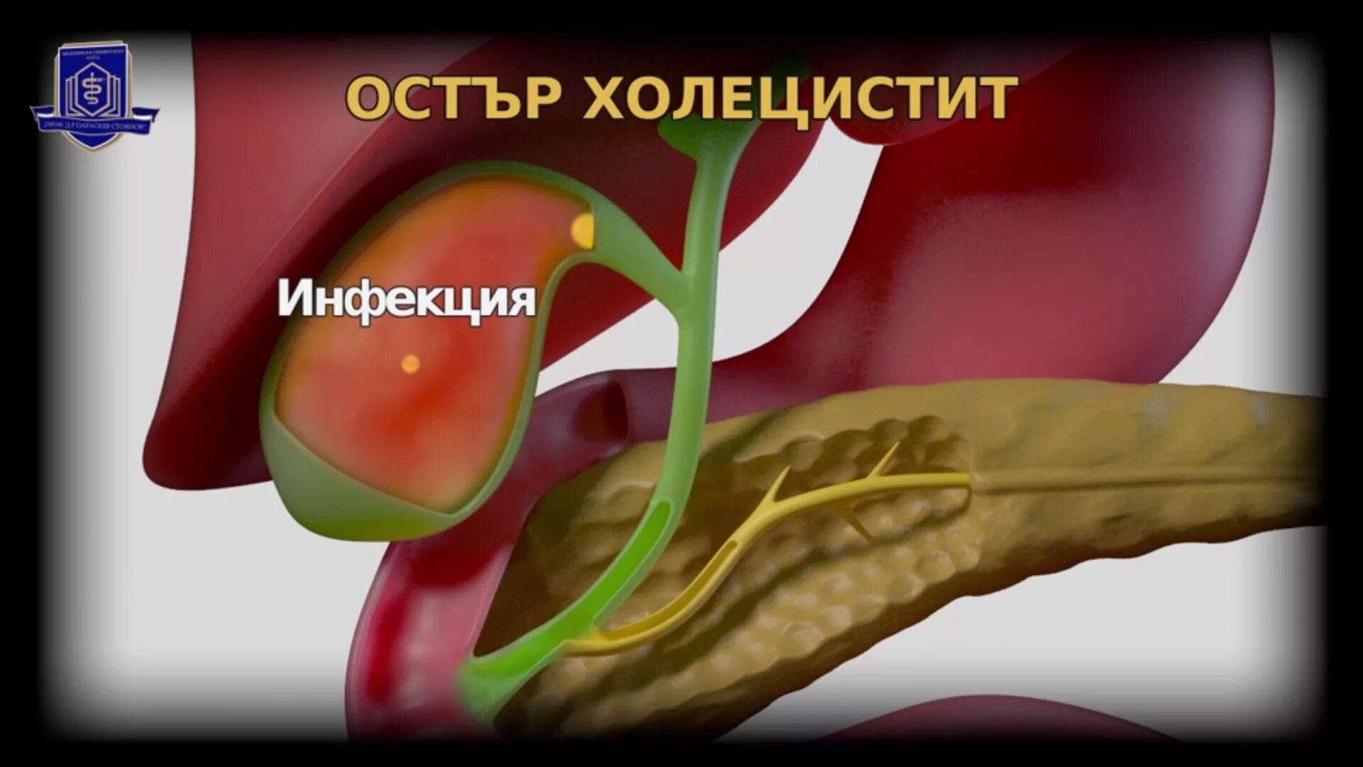 Воспаление печени и желчного пузыря. Острый Гнойный холангит. Хронический холангит. Холангит желчного пузыря.