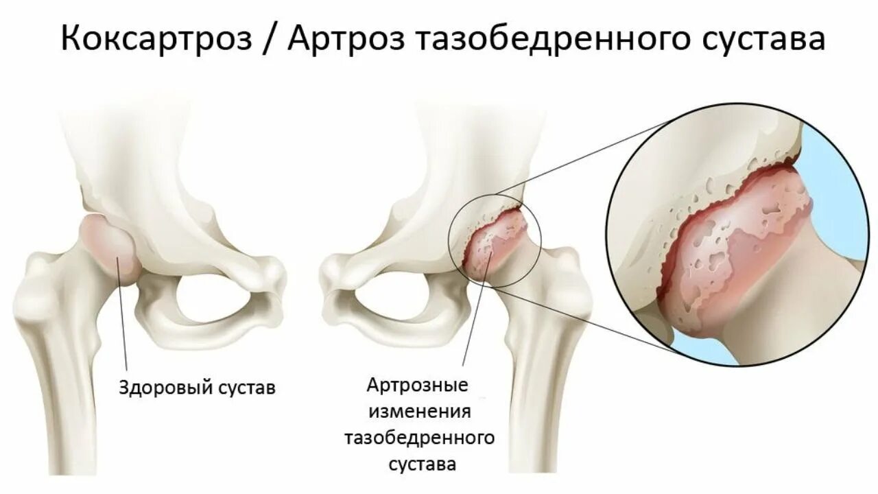 Артроз операция тазобедренного сустава. Коксартроз тазобедренного сустава. Коксит тазобедренного сустава. Бурсит и артроз тазобедренного сустава. Коксо артроз бедренного сустава симптомы.