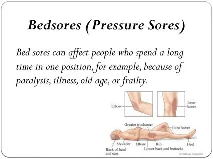 Bedsore Prevention- How to Treat & Diagnose Ulcers/Sores.