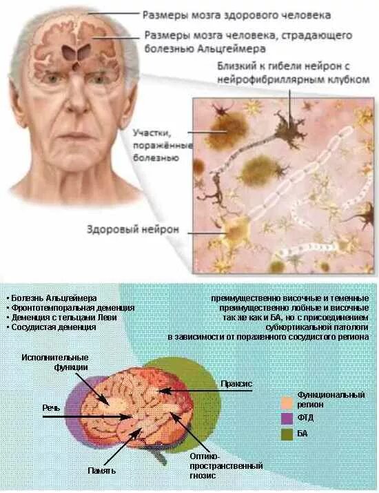 Болезнь заболевание мозга. Болезнь Альцгеймера. Болезнь Альцгеймера мозг. Болезнь Альцгеймера симптомы. Мозг больного Альцгеймером.