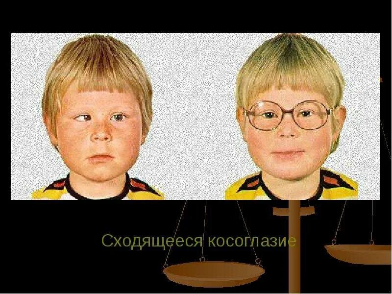 Амблиопия степени у взрослых. Сходящееся косоглазие. косоглазие и амблиопия. амблиопия вследствие анопсии. люди с амблиопией.