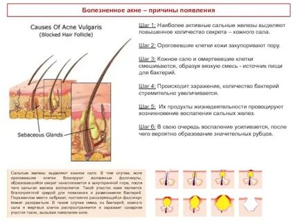Сальный секрет кожи