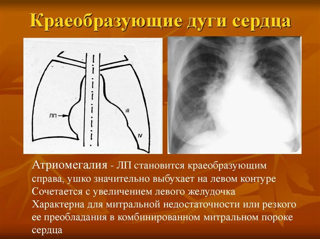 Удлинена дуга. Дуги сердца на рентгенограмме. Краеобразующие дуги сердца. Дуги контура сердца на рентгенограмме. Контуры сердца на рентгенограмме.