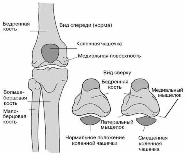 Отек медиального мыщелка. Дисплазия мыщелка бедренной кости коленного сустава. Дисплазия мыщелков бедренной кости. Анатомия бедренной кости и коленного сустава. Дисплазия коленной чашечки.