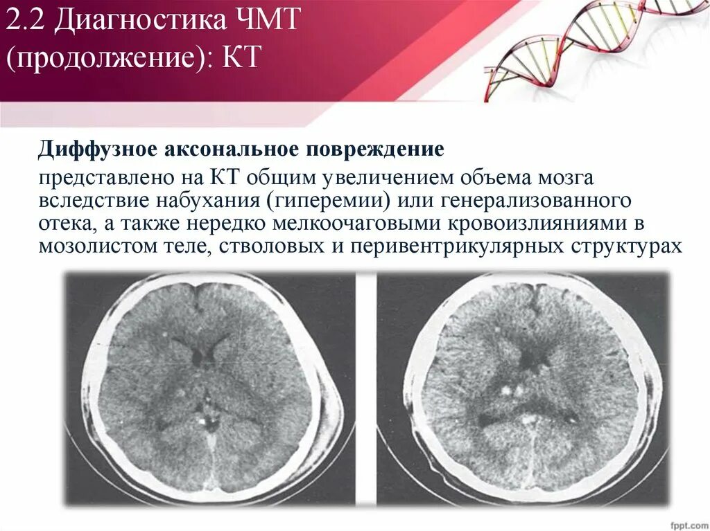 Аксональное повреждение головного. Диффузное аксональное повреждение кт. Диффузное аксональное повреждение головного мозга. Диффузное аксональное повреждение головного мозга симптомы.