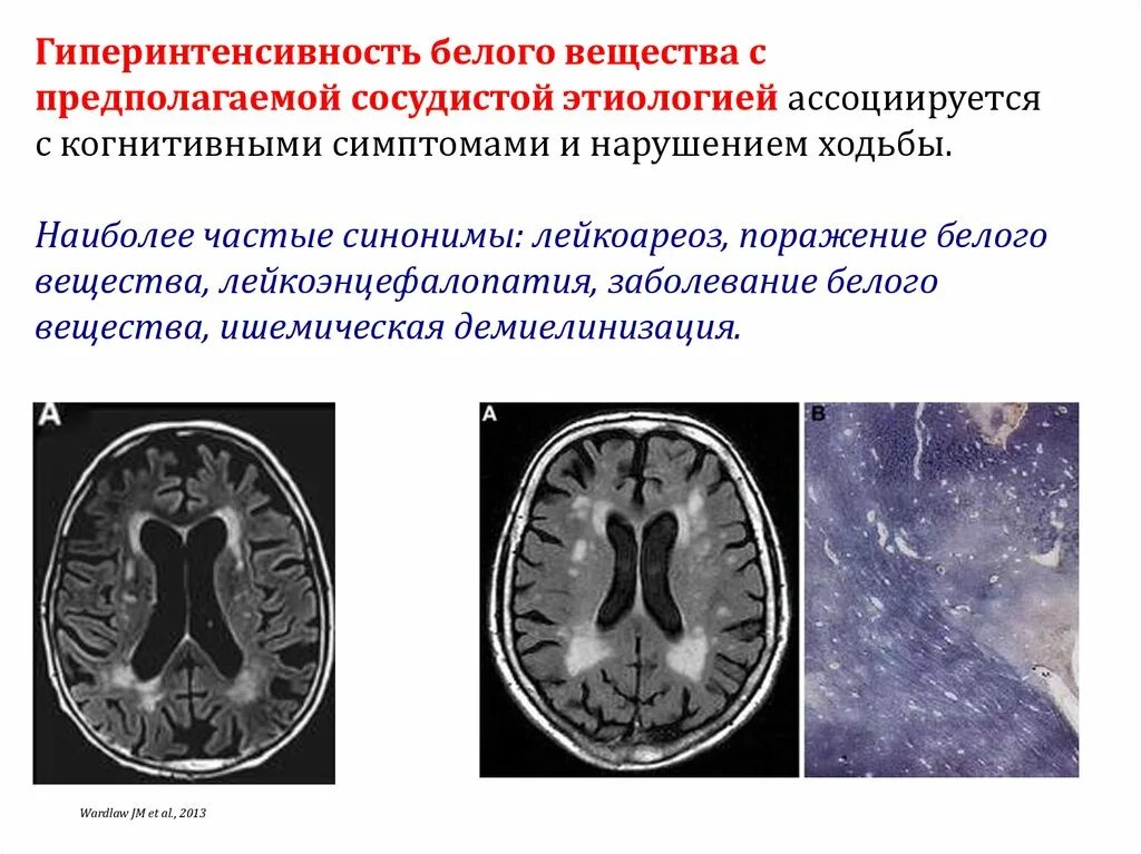 Дисциркуляторная энцефалопатия кт мрт. Лейкоареоз головного мозга на кт. Кт картина дисциркуляторной энцефалопатии. Дисциркуляторная энцефалопатия патогенез. Поражение белого вещества мозга