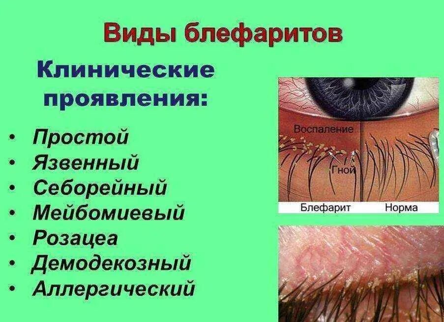 Блефарит: симптомы и лечение