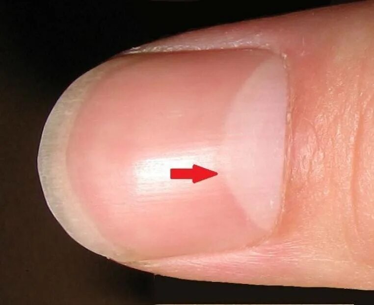 белые пятна на указательном пальце