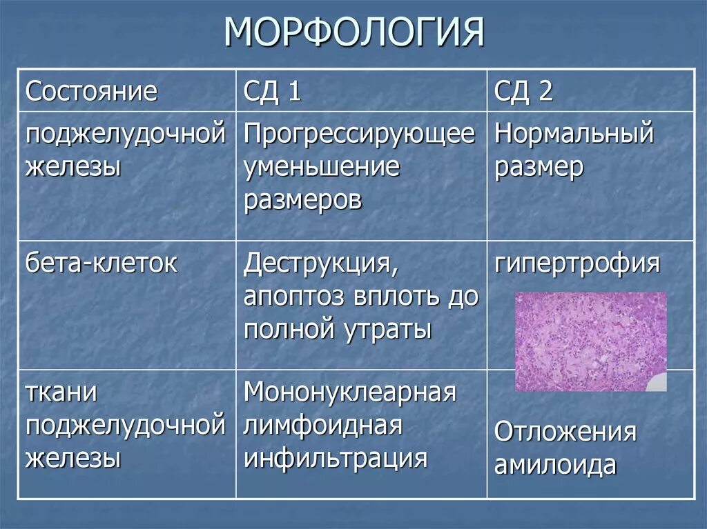 Различия сахарного диабета 1 и 2. Морфология поджелудочной железы. Диабет 1 типа морфология. Таблица сахарного диабета 1 типа. Морфология поджелудочной железы при сахарном диабете.