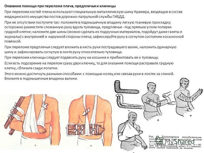 Алгоритм помощи при переломах. Транспортная иммобилизация при переломе плечевой кости. Перелом плеча иммобилизация шиной Крамера. Перелом плечевой кости наложение шины Крамера. Шина Крамера на ключицу.