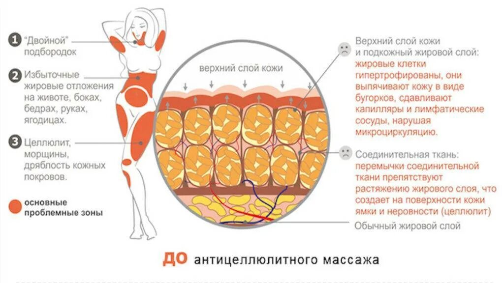 Как убрать внутренний жир. Целлюлит жировые клетки. целлюлит подкожный жир. целлюлит строение жировой ткани. строение жировой ткани женщины.