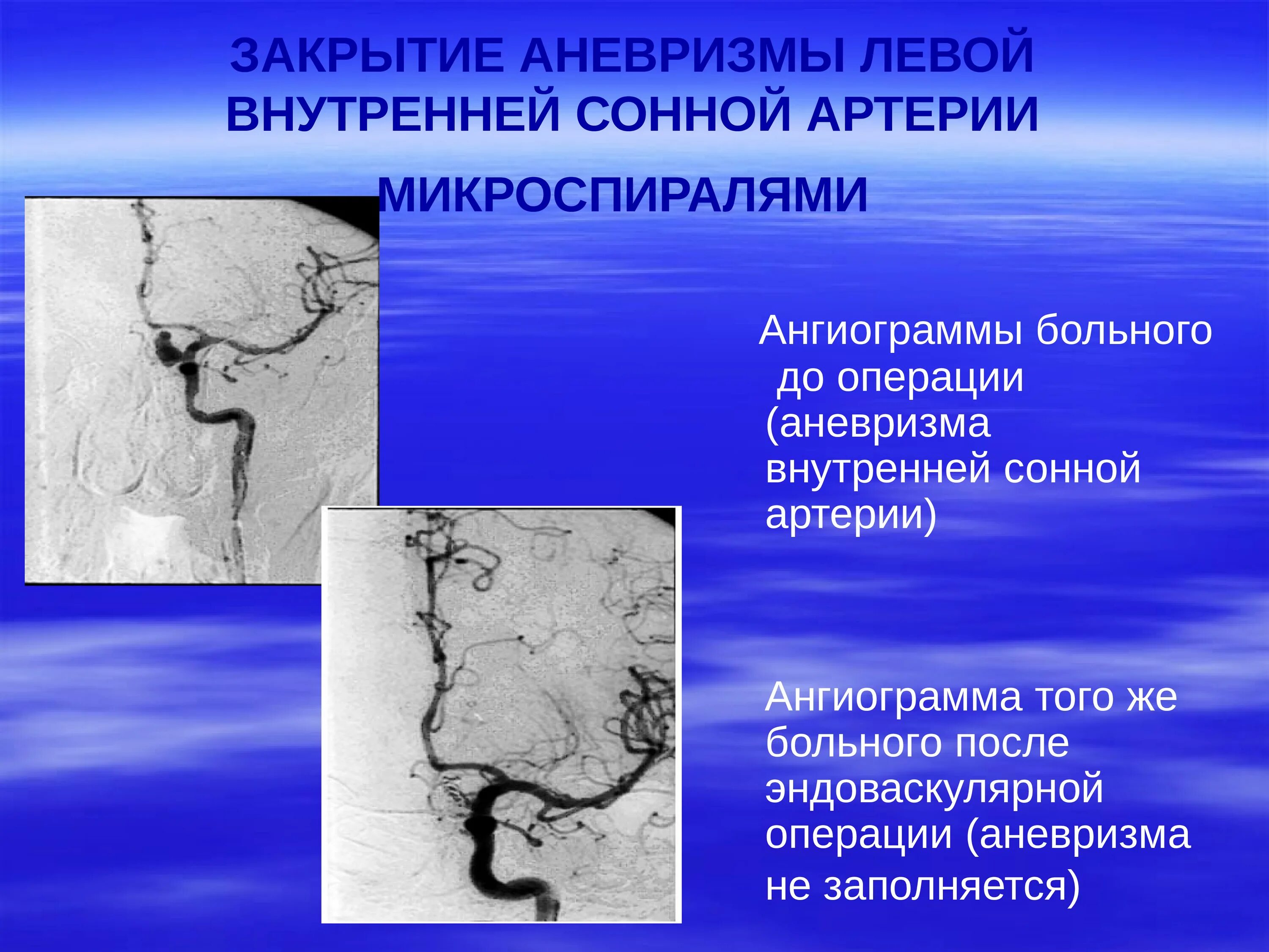 Аневризма сонной артерии что это. Аневризма внутренней сонной артерии классификация. Фузиформное расширение внутренней сонной артерии. Мешотчатая аневризма внутренней сонной артерии. Фузиформная аневризма внутренней сонной артерии.