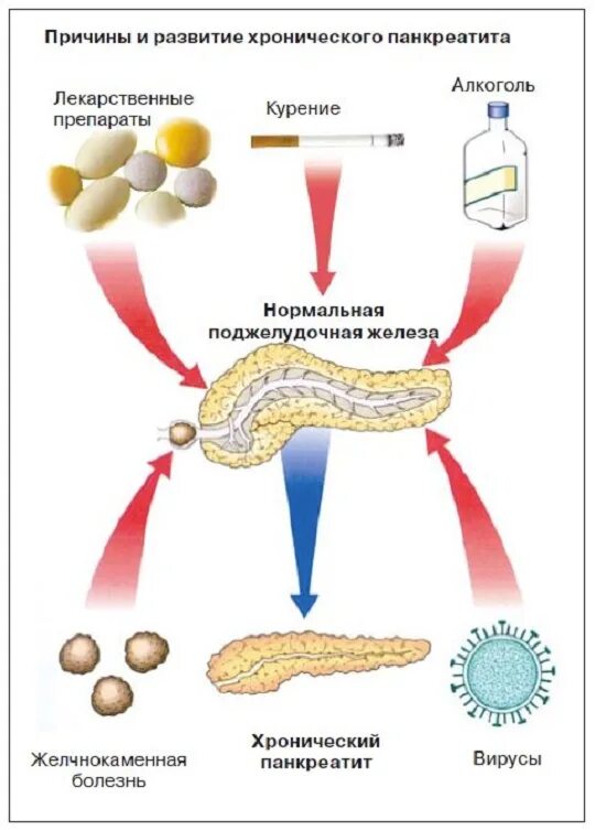 Профилактика хронического панкреатита. Факторы способствующие развитию хронического панкреатита. Эпидемиология хронического панкреатита. Этиологические факторы хронического панкреатита. Факторы риск панкреатита.