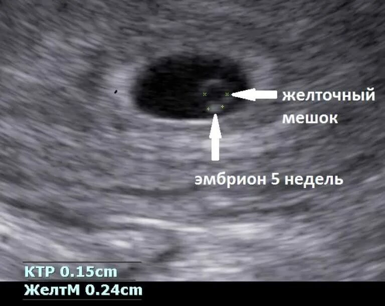 Плодное яйцо 7 мм желточный мешок 2 мм. Плодное яйцо на УЗИ 5 недель беременности фото. Плодное яйцо 3мм и желточный мешок 3мм. Плодное яйцо 9мм желточный мешочек 3.2 мм. 7 неделя не видно эмбриона