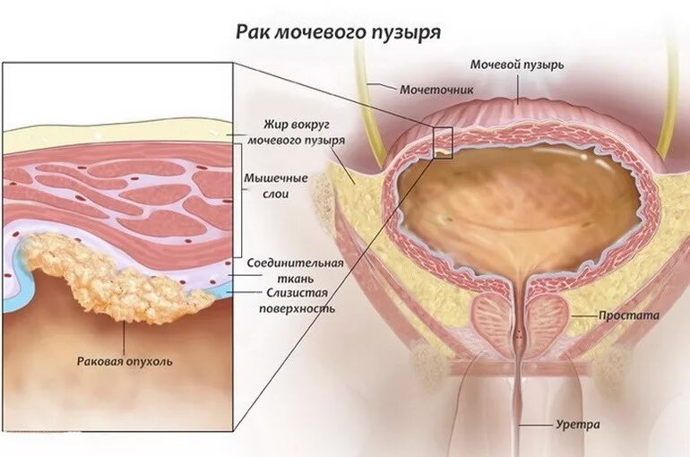 Лечение рака мочевого пузыря у мужчин. Опухоль мочевого пузыря. Объемное образование мочевого пузыря. Злокачественная опухоль мочевого пузыря. Неоплазия мочевого пузыря.