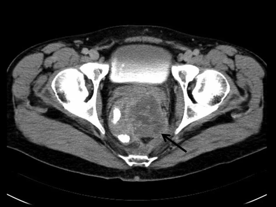 Опухоль предстательной железы кт. Магнитно-резонансная томографии (мрт) предстательной железы. Предстательная железа на томограмме. Кт предстательной железы с контрастированием. Аденома простаты мрт