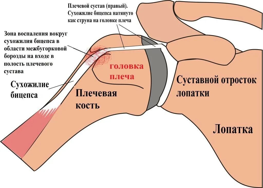 Болит плечо при поднятии. Сухожилие длинной головки двуглавой мышцы плеча. Болитплечевойй сустав.