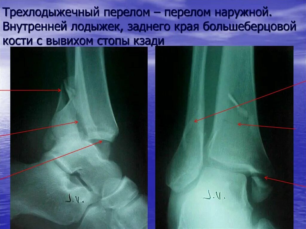 Трещина наружной. Перелом внешней лодыжки рентген. Перелом латеральной лодыжки. Перелом лодыжки большеберцовой кости. Супинационно-аддукционный перелом лодыжки.