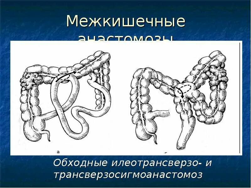 Заболевания ободочной кишки. Обходной трансверзосигмоанастомоз. межкишечный илеотрансверзоанастомоз. обходной илеотрансверзоанастомоз анастомоз. обходной анастомоз толстой кишки.