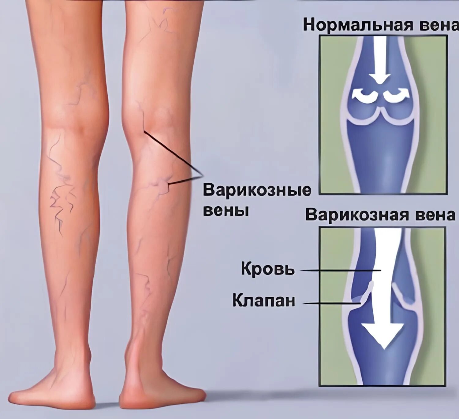 Варикозное расширение вен нижних конечностей. Варикозное расширение вен (ВРВ) нижних конечностей. Нормальная и варикозная Вена. Варикозно расширенные вены ног. Что значит расширение вен