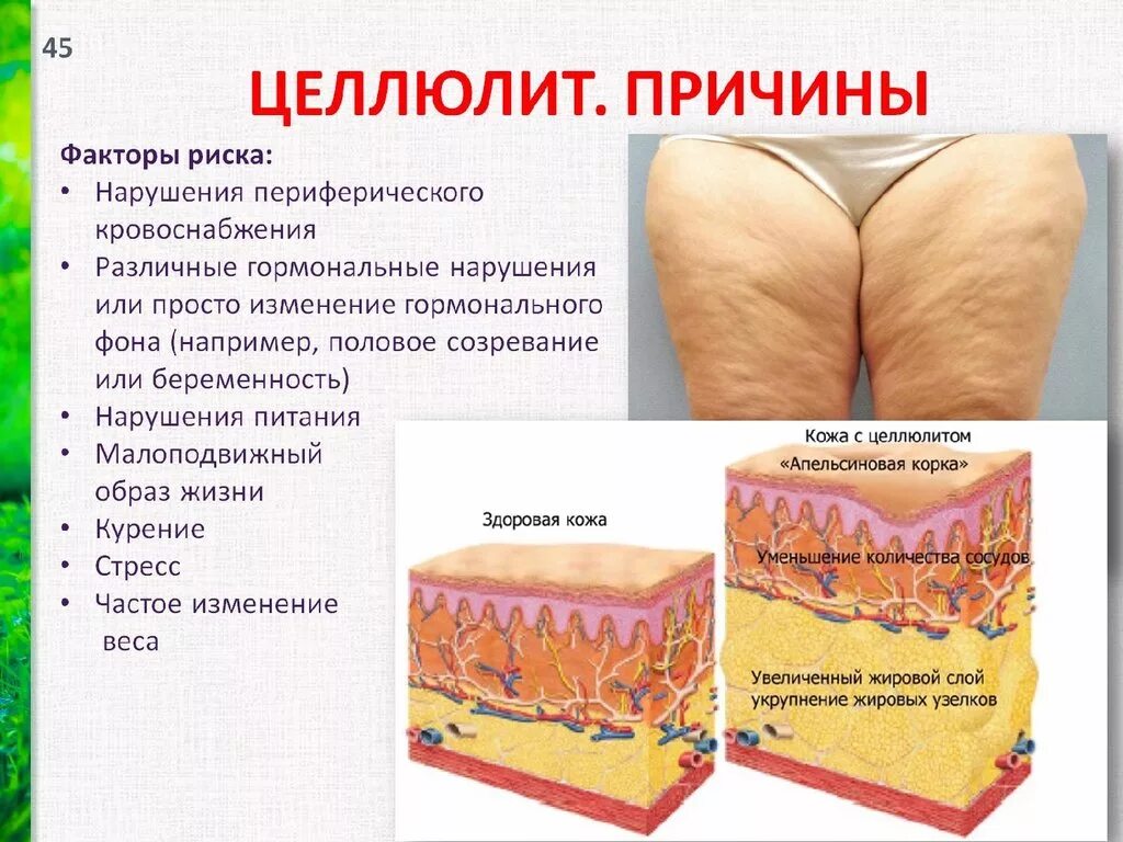 Почему появляется изменения. Причины целлюлита. Целлюлит причины возникновения.