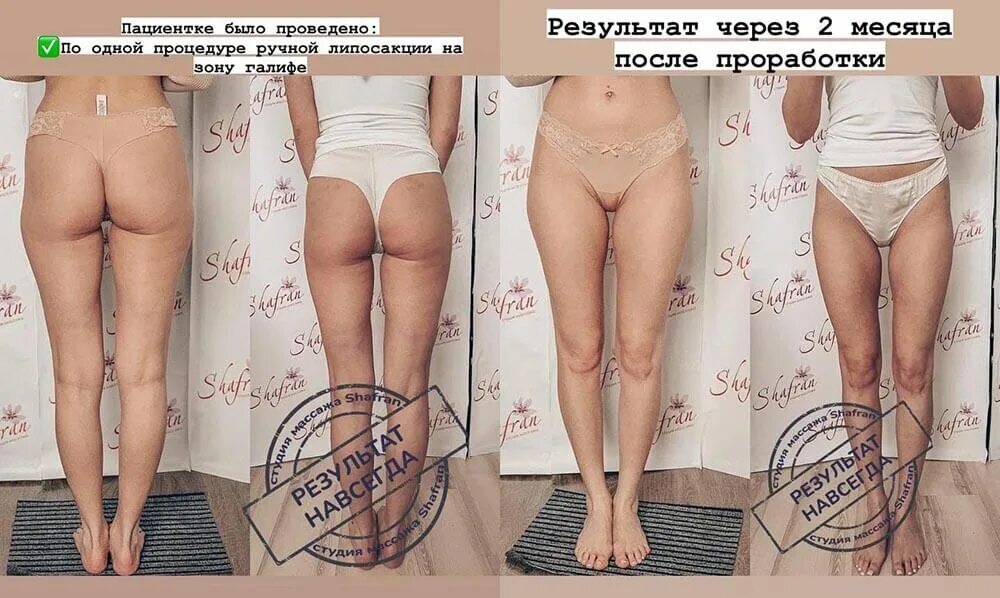 Липосакция галифе до и после отзывы Картинки ЛИПОСАКЦИЯ БЕДЕР