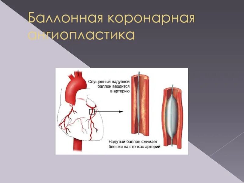 Баллонная коронарная ангиопластика. Баллонная ангиопластика. Баллонная ангиопластика по Зубкову. Коронная ангионопластика.