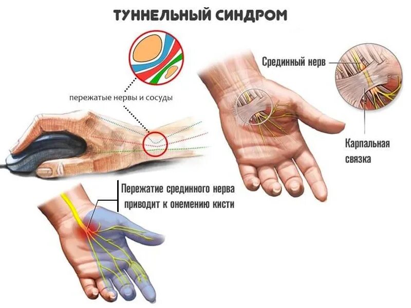 Что делать если очень сильно болит рука. .Туннельный синдром запястья туннельный. Синдром карпального канала кисти. Симптомы туннельного синдрома запястного канала. Карпальный нерв запястья руки.