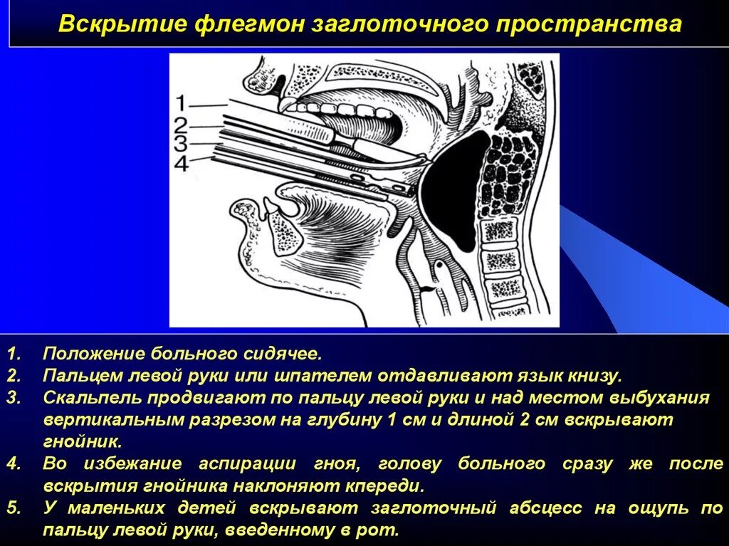 Операция абсцесс шеи. Ретрофарингеальный абсцесс вскрытие. Флегмона окологлоточного пространства шеи. Вскрытие заглоточного абсцесса. Вскрытие ретрофарингеальной флегмоны.