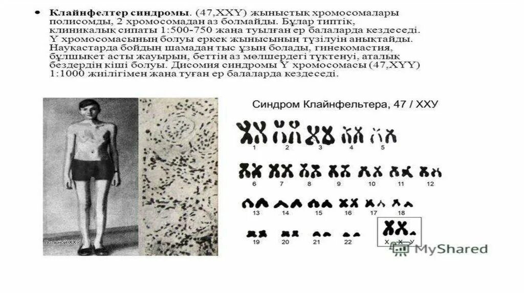 Тип наследования клайнфельтера. 47 хромосом синдром клайнфельтера. кариотип человека с синдромом клайнфельтера. синдром клайнфельтера тип наследования аутосомно доминантный. синдром клайнфельтера кариотип.