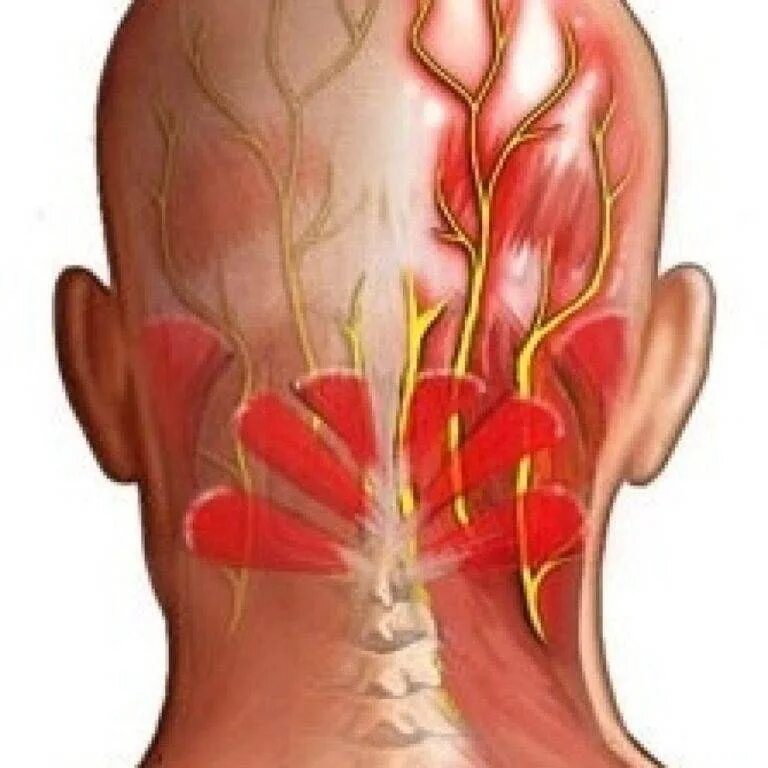 Сильно пульсирует шея. Нейропатия затылочного нерва. Защемление невралгия тройничного нерва. Невралгия затылочного нерва симптомы. Нейропатия затылочного нерва блокада.