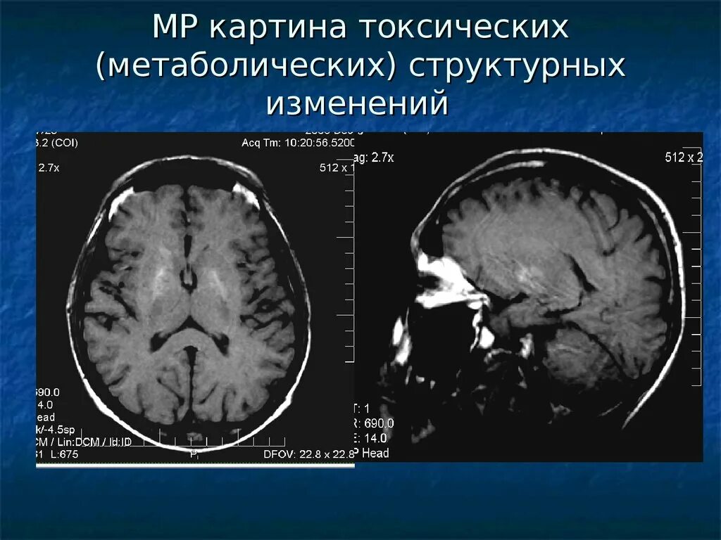 Токсическое поражение головного мозга мрт. Метаболические поражения головного мозга мрт. Нейродегенерации мрт. Токсическое поражение мозга кт. Изменение ликворокистозного характера