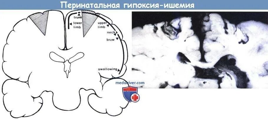 Гипоксическая ишемическая энцефалопатия новорожденного. Гипоксическая травма головного мозга. Ишемия 1-2 степени у новорожденных. Перинатальная гипоксия ишемия. Ишемия мозга форум