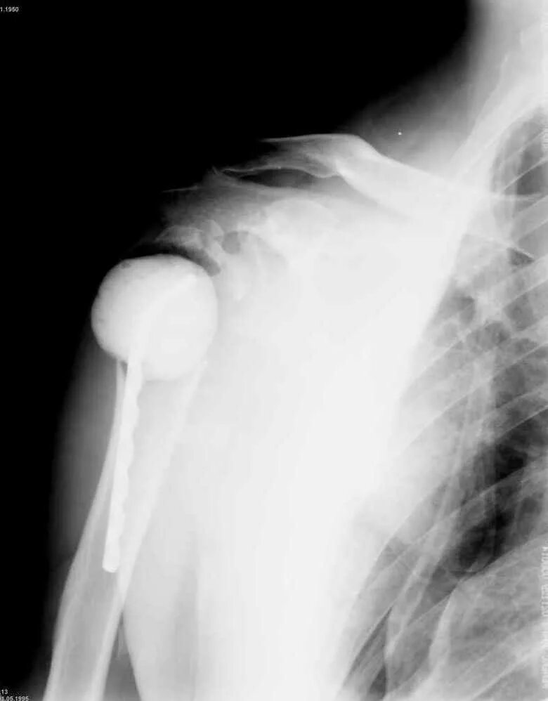 сроки переломов плечевой кости. остеосинтез плечевого сустава. нижний подвывих плечевой кости.