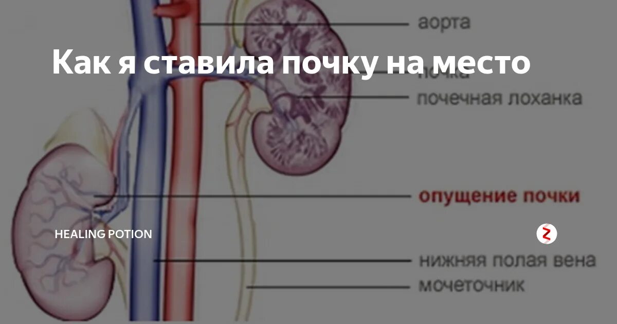 Как лечить опущение почки. Нефроптоз почек симптомы. опущение почки у женщин.