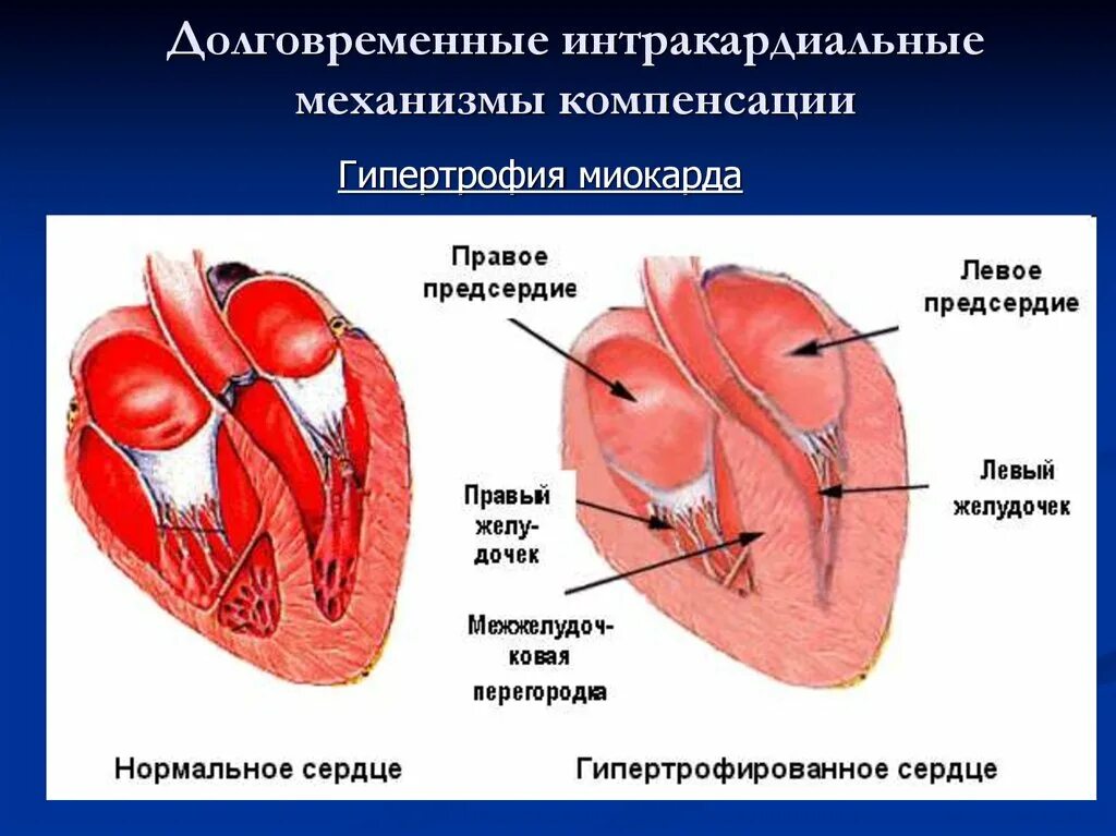 Спортивное сердце гипертрофия миокарда. Симметричная гипертрофия миокарда. Правый желудочек сердца.