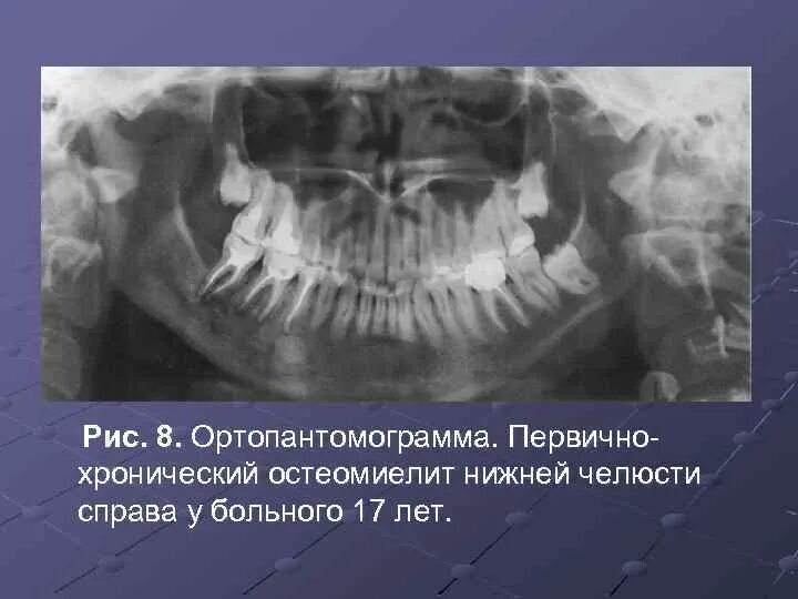 Хронический одонтогенный остеомиелит челюстей у детей. Клиника, диагностика и ле