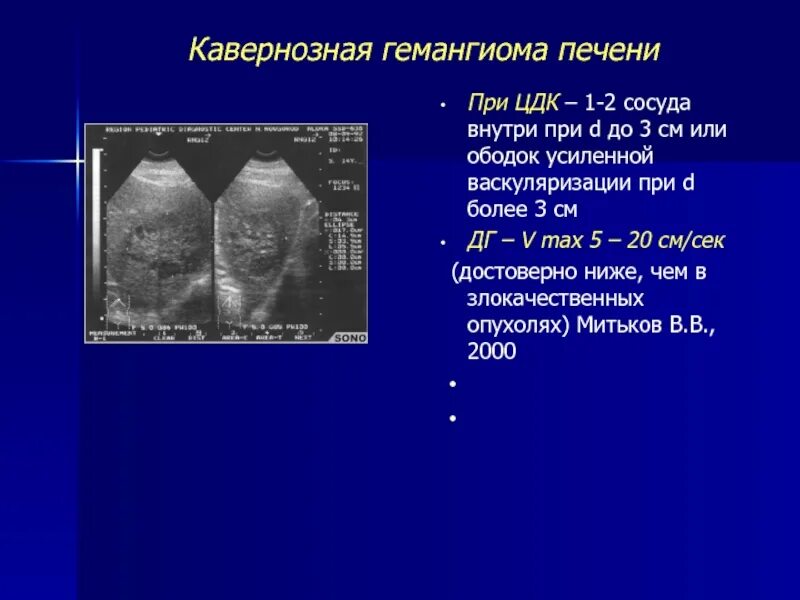 При гемангиоме печени можно ли. Кавернозной формы гемангиомы печени УЗИ. Кавернозная гемангиома левой доли печени что это такое-. Гемангиомы печени при УЗИ.