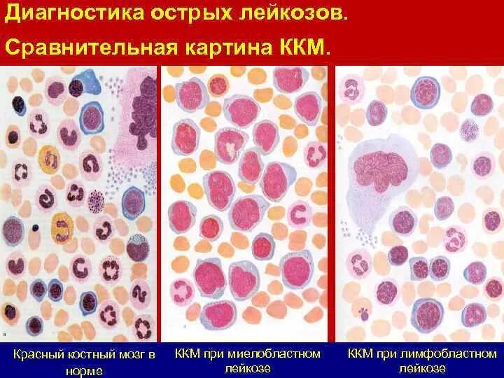 Костный мозг при миелобластном лейкозе. Костный мозг при остром лимфобластном лейкозе. Острый лейкоз костный мозг. Исследование пунктат костного мозга при миелобластном лейкозе.