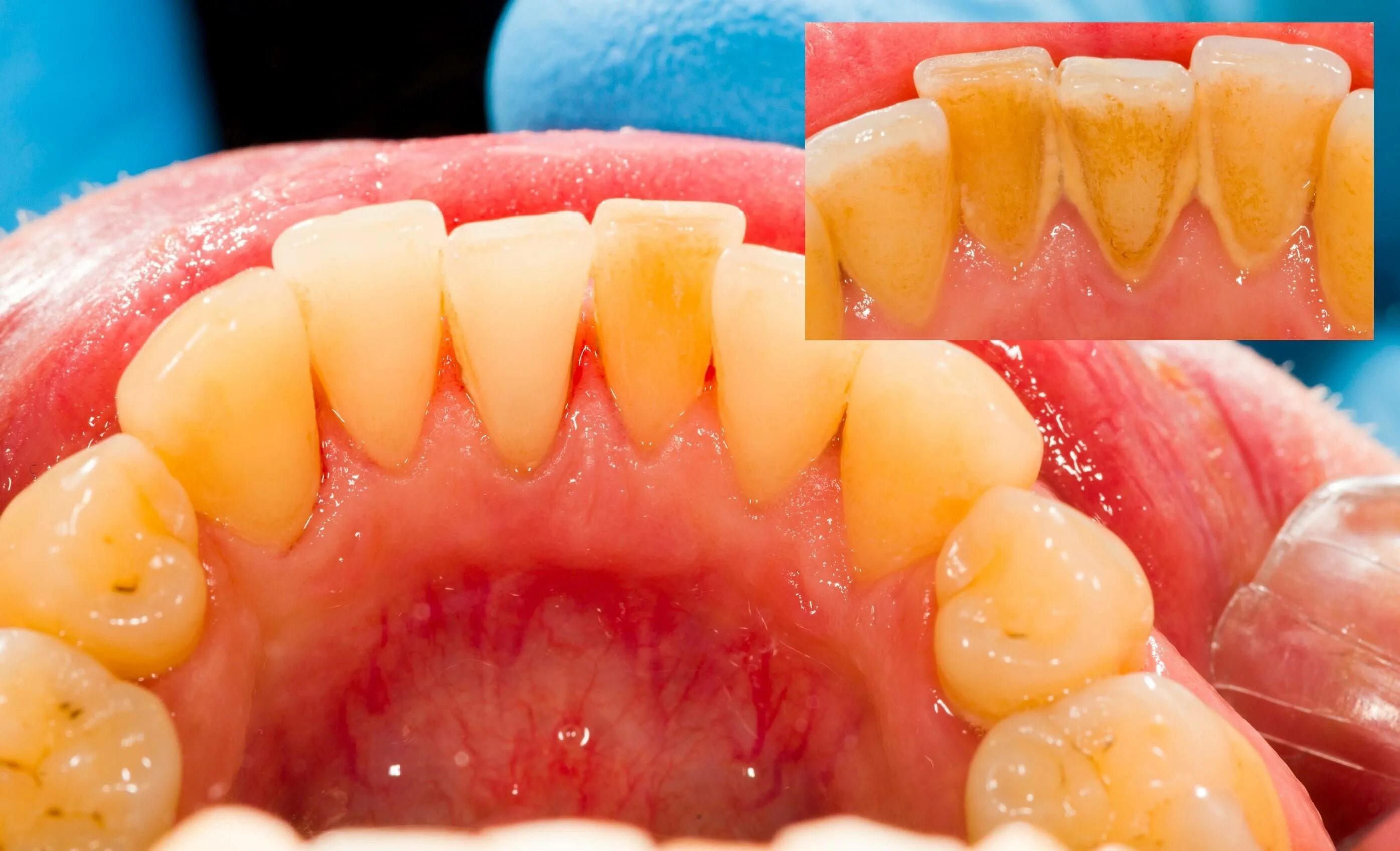 Со внутренней стороны. Пришеечный зубной камень. Пародонтит зубной камень. Поддесневой зубной камень. Поддесневой белый зубной камень.