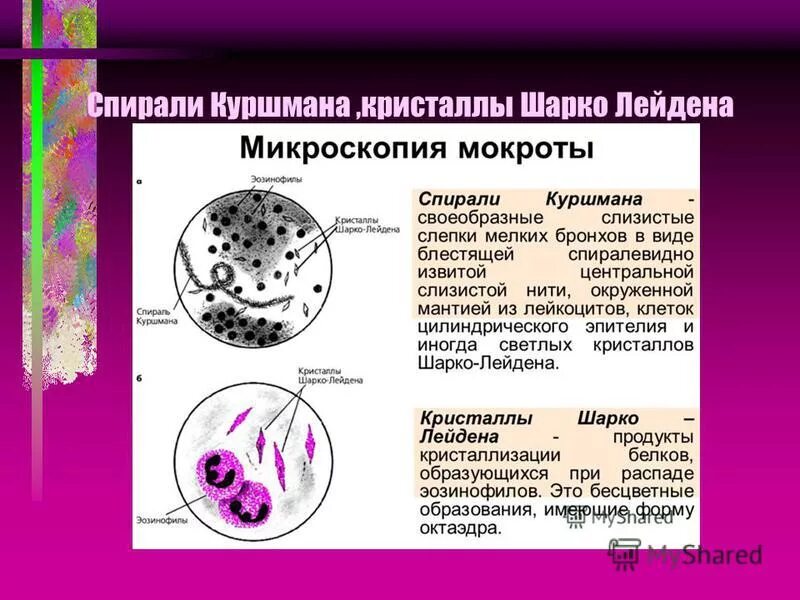 Кристаллы шарко лейдена. Спирали куршмана и кристаллы шарко-лейдена. спирали куршмана и кристаллы шарко-лейдена и эозинофилы в мокроте. микроскопия мокроты спирали куршмана. спирали куршмана и кристаллы шарко лейдена при бронхиальной астме.