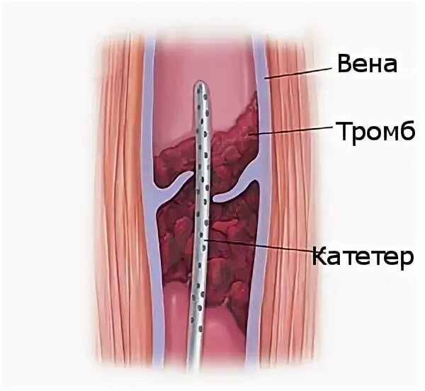 Что такое тромб и как он. Регионарный тромболизис.