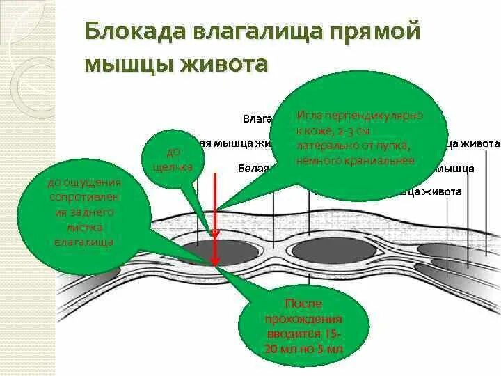 Нервная блокада. Проводниковая блокада прямой мышцы живота. Топография влагалища прямой мышцы живота. Блокада влагалища прямой мышцы живота. Влагалище прямой мышцы живота схема.