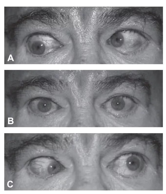Двоение в глазах лечение. Бинокулярная диплопия. Бинокулярная диплопия при катаракте. Бинокулярная диплопия причины.