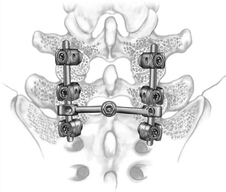 Операция транспедикулярная фиксация позвоночника. Транспедикулярный остеосинтез. Остеосинтез позвонков. Транспедикулярный фиксатор позвоночника. Конструкция позвоночника операция