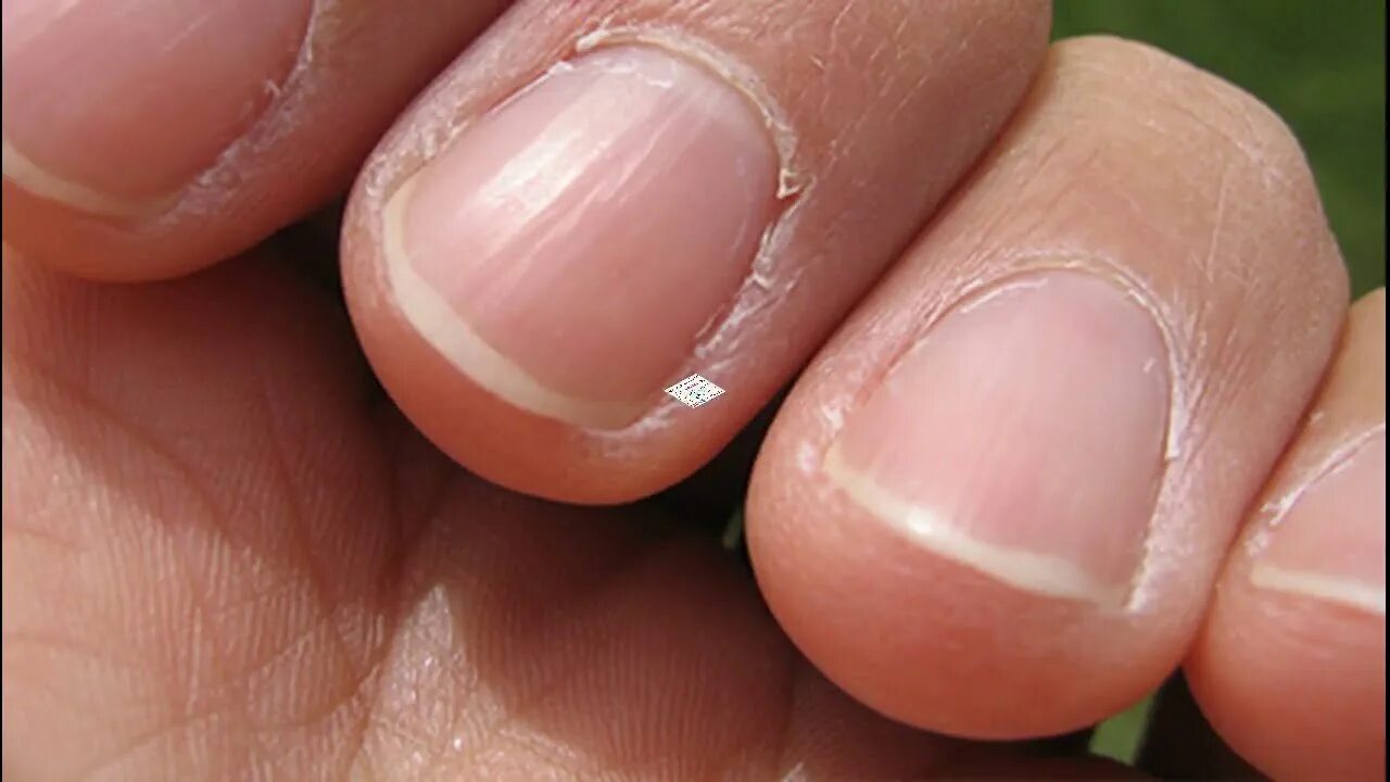 Короткие ногти на руках. Ногтевая пластина. Маленькие ногтевые пластины. Пропилы ногтевой пластины