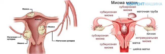 Миома по передней стенке матки. Миома по передней стенке матки